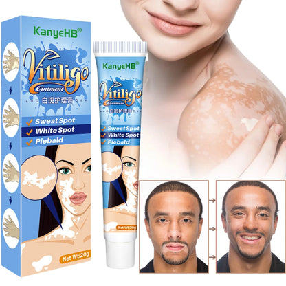 Crema KanyeHB para el tratamiento del vitíligo